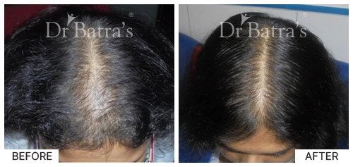 Hair Falling Treatment