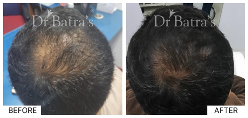 Hair Falling Treatment