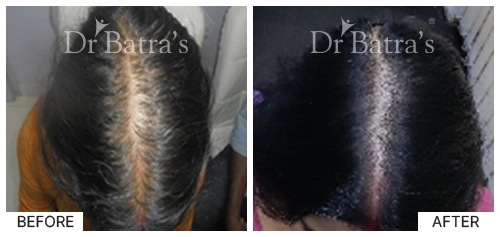 Hair Falling Treatment