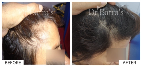 Hair Falling Treatment