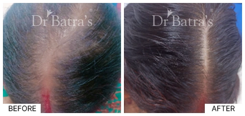 Hair Falling Treatment