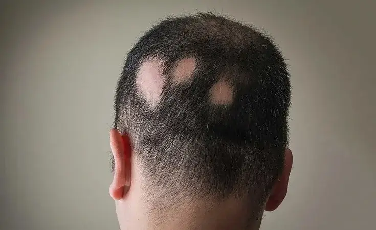 Alopecia Areata <br>Treatment