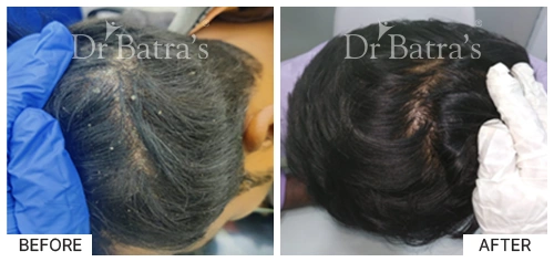 Hair Falling Treatment