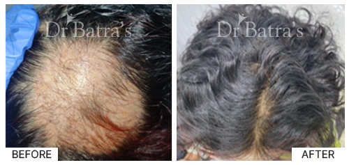 Hair Falling Treatment