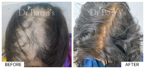 Hair Falling Treatment