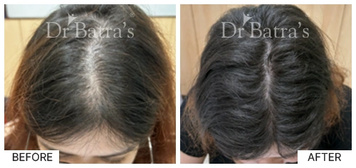 Hair Falling Treatment