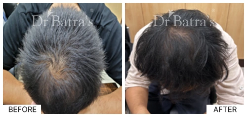 Hair Falling Treatment