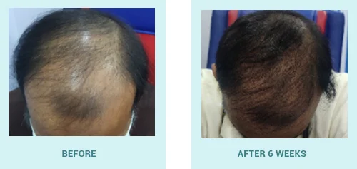 Dr Batra's® New Hair Treatment Vs Dr Batra's® Grohair Treatment