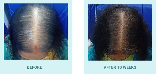 Hair Transplant in Ahmedabad  Best Results  Cost of Hair Transplant in  Ahmedabad  YouTube