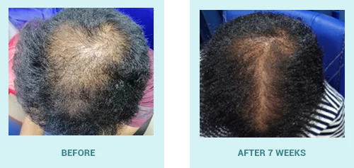 Hair Loss Treatment In Ajmer - View Cost, Book Appointment Online | Practo