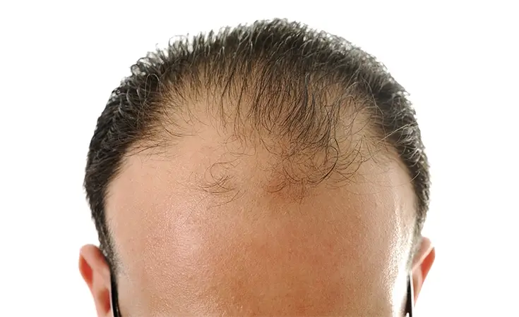 Male Pattern Baldness<br>Treatment