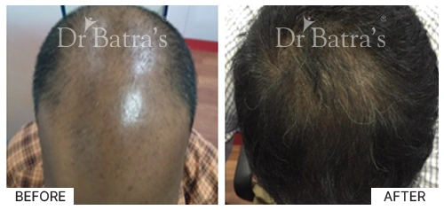 Hair Falling Treatment