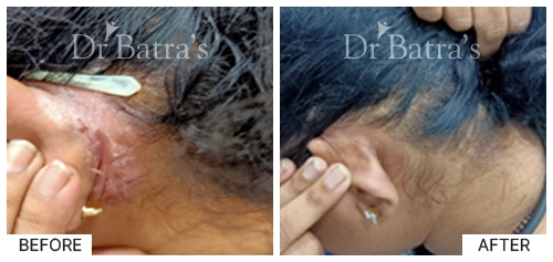 Hair Falling Treatment