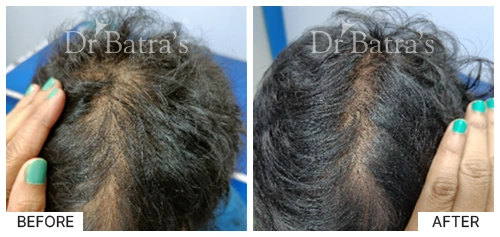 Hair Falling Treatment