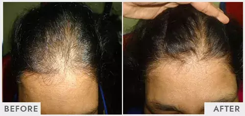 Hair Falling Treatment